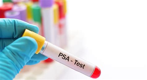 Prostate Specific Antigen (PSA) Test .